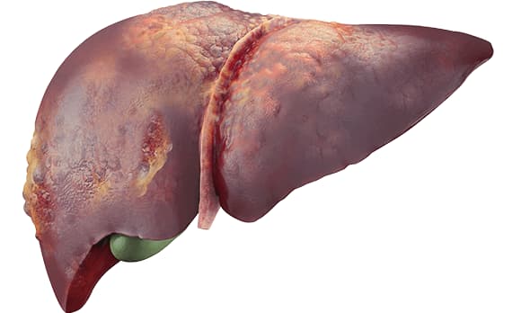 An Image of a Liver with Hepatocellular Carcinoma
